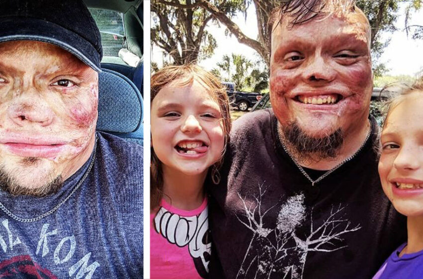 “Suffered a Burn On 98% Of His Body As a Child, In The Future Was Abandoned By His Wife”: The Man Raised His Two Daughters Alone!