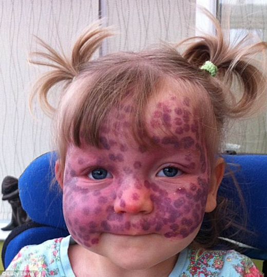 Meet Matilda Callaghan: The Little Girl Covered in Polka Dots!