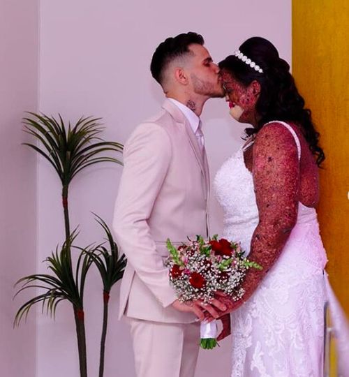 You Won’t Believe How This Woman with a Rare Skin Condition Found Her Soulmate!