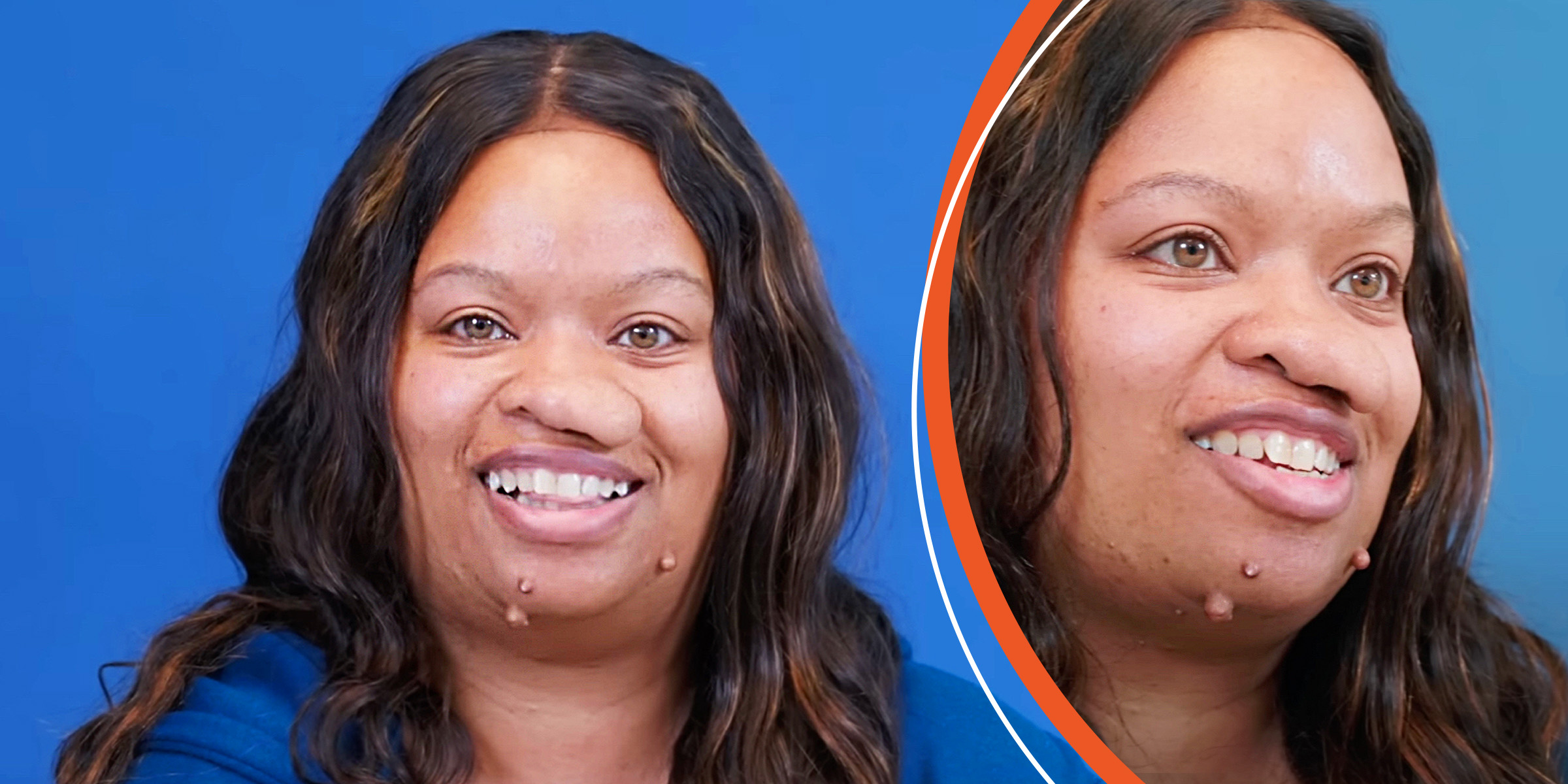 She Had Facial Tumors Since Childhood & After Surgery, Netizens Are in Awe of Her Look – 5 More Inspiring Cosmetic Stories